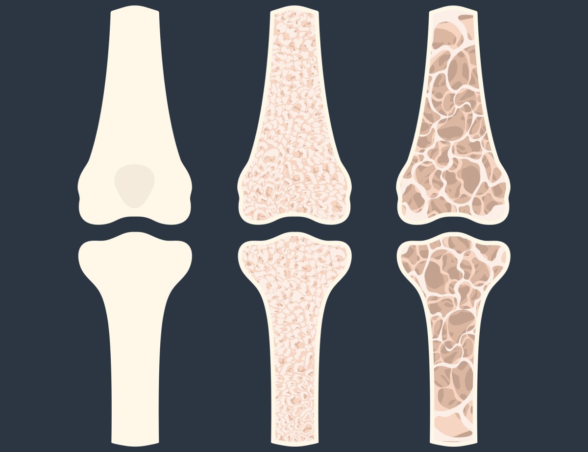 Animation av tre ben som visar osteoporos - benförtunning