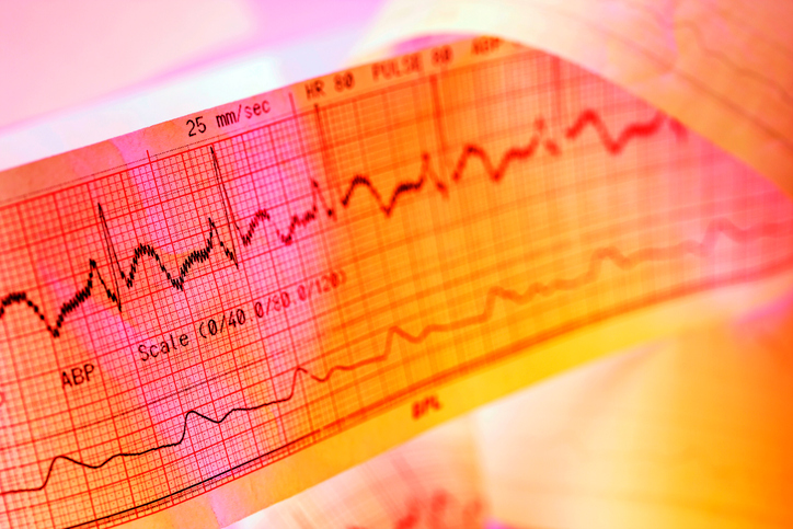 EKG-registrering