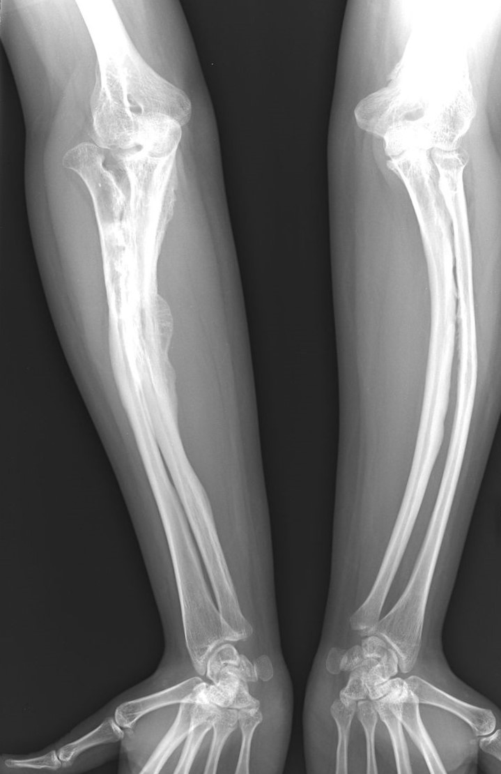 Röntgenbilder av osteogenesis imperfecta-sjukdom hos en vuxen