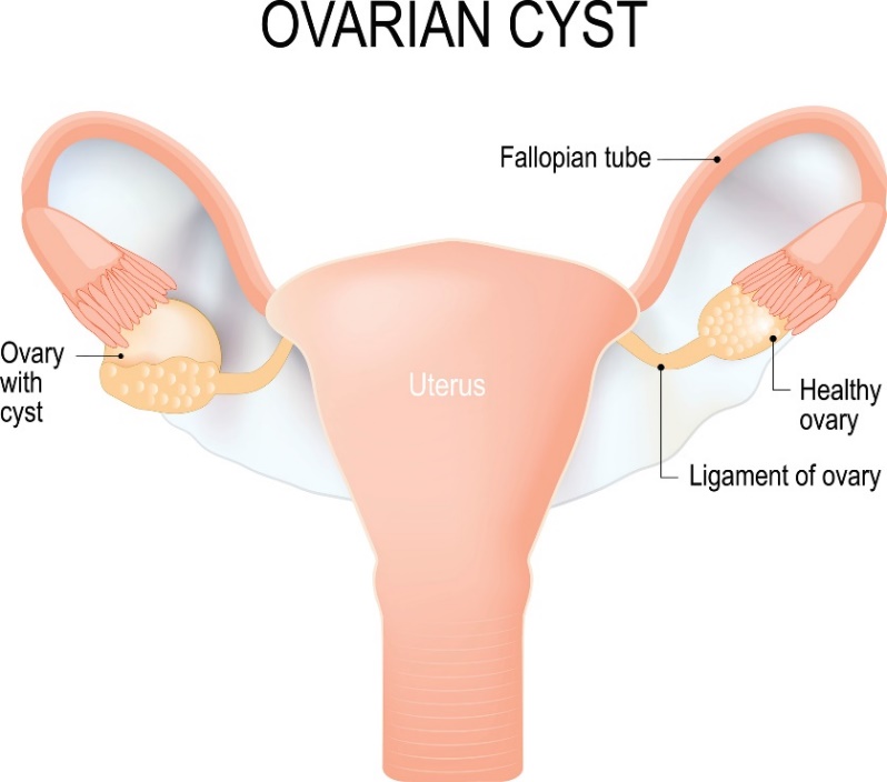 Cysta på äggstocken