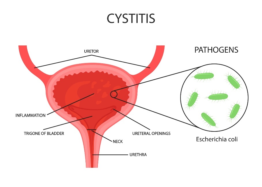 Inflammation i urinblåsan