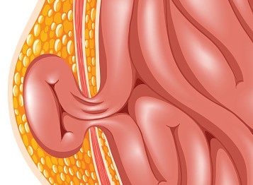 Bråck, den vanligaste komplikationen vid ascites