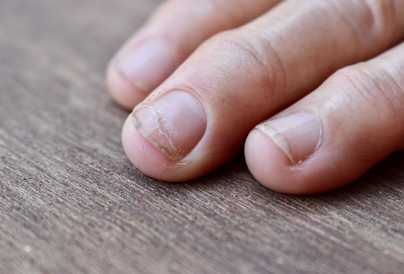 Horisontella spår på naglar - hand, fingrar, naglar