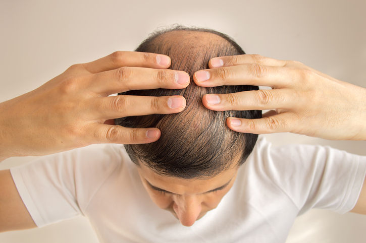 Man har glest hår, håravfall, skallighet eller alopeci, händer på huvudet, vy uppifrån