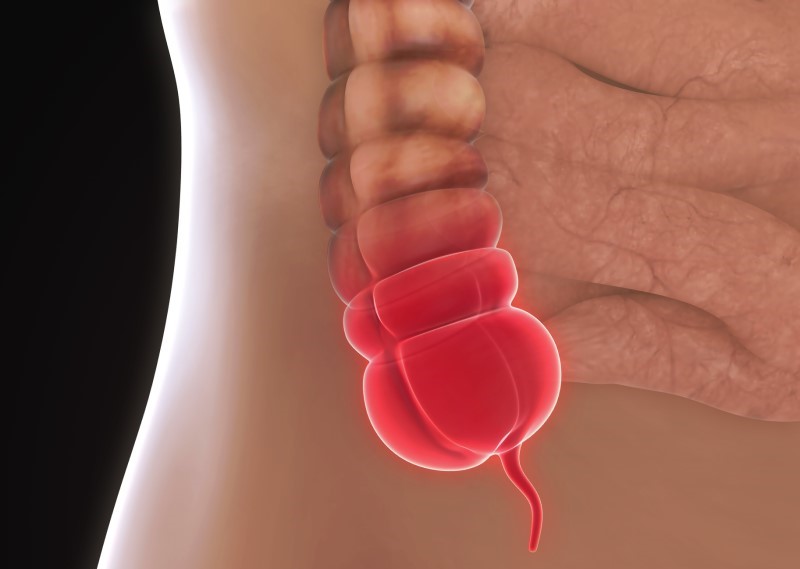 Modell av inflammerad blindtarm - anatomisk vy