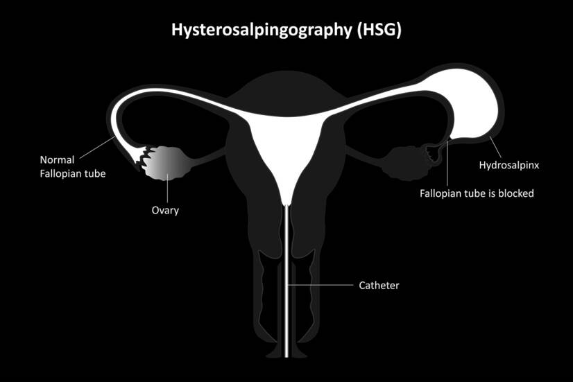 Hysterosalpingografi - källa: Getty Images