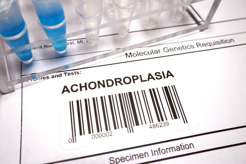 Achondroplasia: Vilka är orsakerna till och symptomen på medfödd benskörhet?