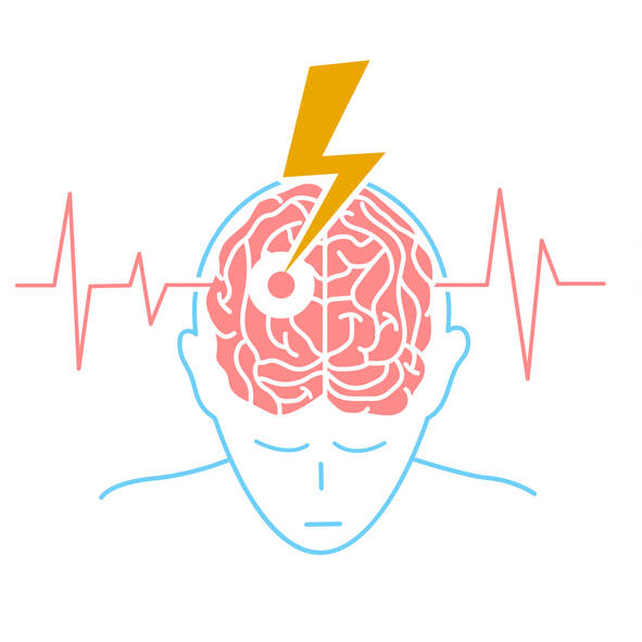 Vad är en stroke? Känner du till symtom, risker och behandling?