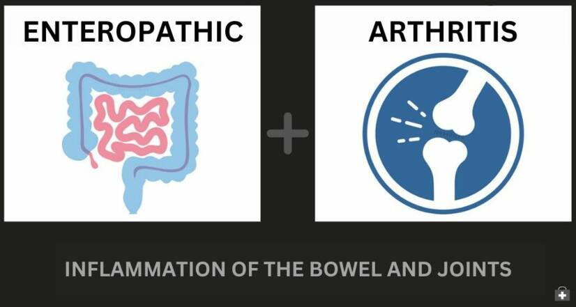 Enteropatisk artrit och inflammatorisk tarmsjukdom: hur är de relaterade + Symtom