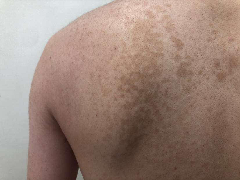 Pityriasis versicolor: Vad är det och vilka symtom har det? Orsaker och överföring