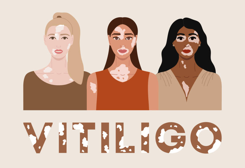 Vitiligo: Vad är vitiligo och vilka är dess orsaker och symtom? När börjar det?