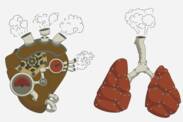 Pulmonell hypertension: vad är det och varför uppstår det? + Symtom och behandling